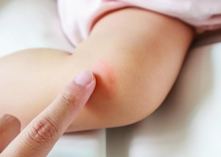 Muỗi và trẻ sơ sinh: Làm thế nào để bảo vệ bé khỏi cắn muỗi?