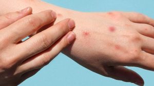 Làm Gì Khi Bọ Chét Cắn Và Cách Phòng Tránh Bọ Chét Cắn
