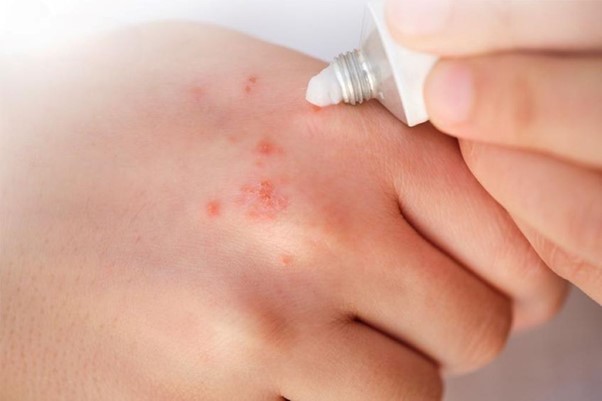 Bị con bù mắt cắn phải làm sao ?