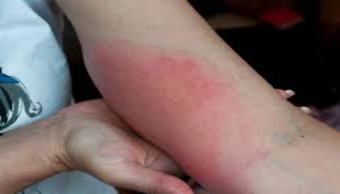 Bị ong bắp cày đốt có nguy hiểm không?