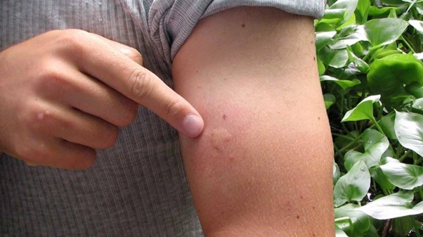 Bị ong vàng đốt 1 nốt có sao không?