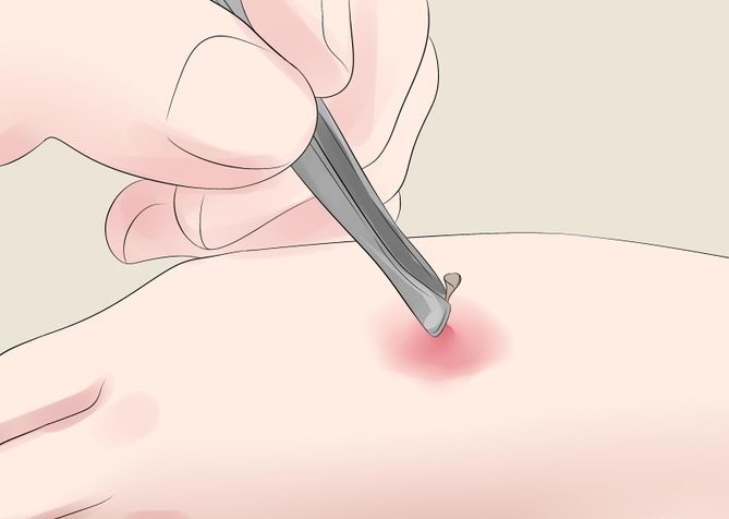 Loại bỏ ngòi đốt trên da