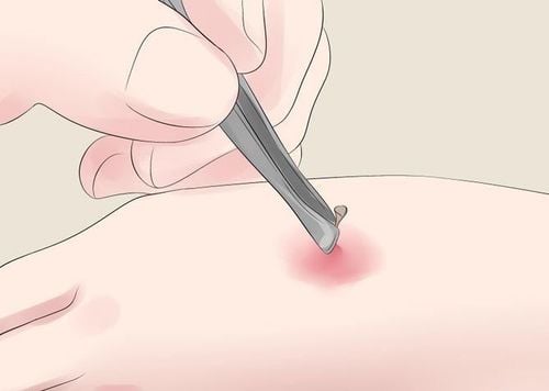 Vết cắn của ong bắp cày sẽ như thế nào