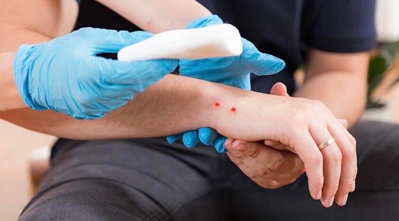 Bị rắn cắn thì nên làm gì? Các bước sơ cứu khi rắn cắn