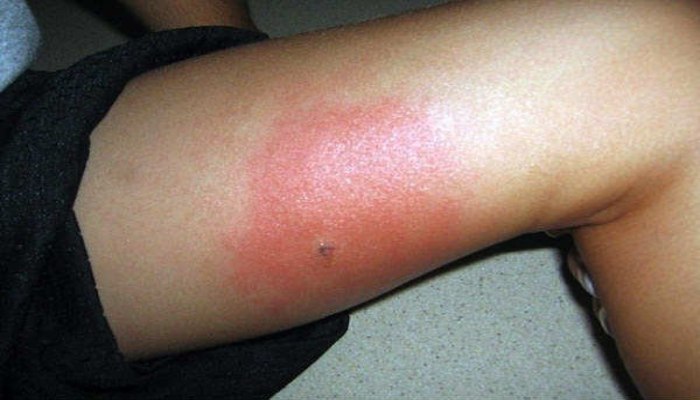 Bọ cạp đen có độc không? - Những triệu chứng nguy hiểm khi bị bọ cạp đen cắn