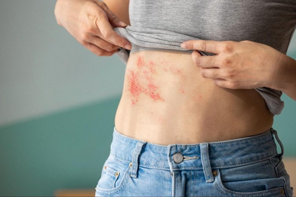 Con giời leo gây ra bỏng rát, phồng rộp