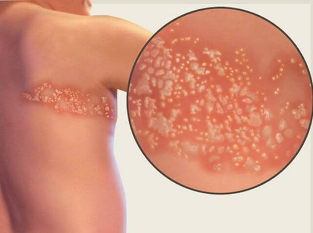 Cách chữa trị giời leo cắn tại nhà bằng mẹo dân gian