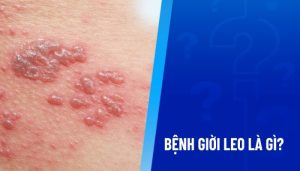 Giải Đáp: Con Giời Leo Có Độc Không?