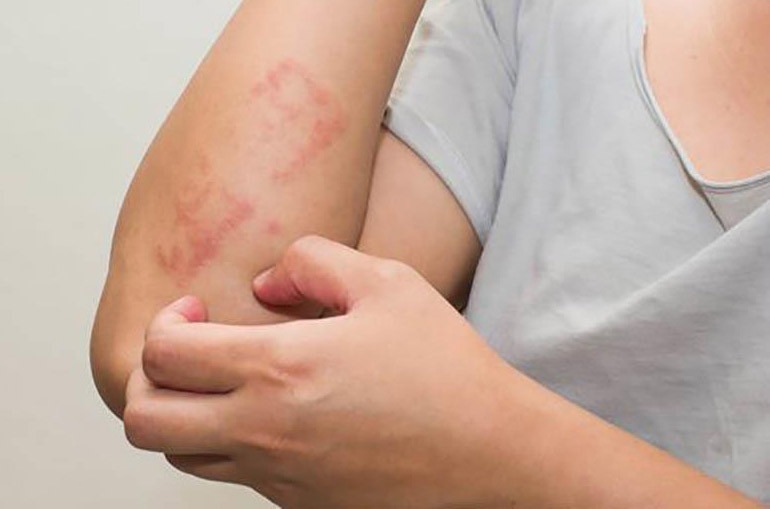 Dị ứng với côn trùng đốt là gì?