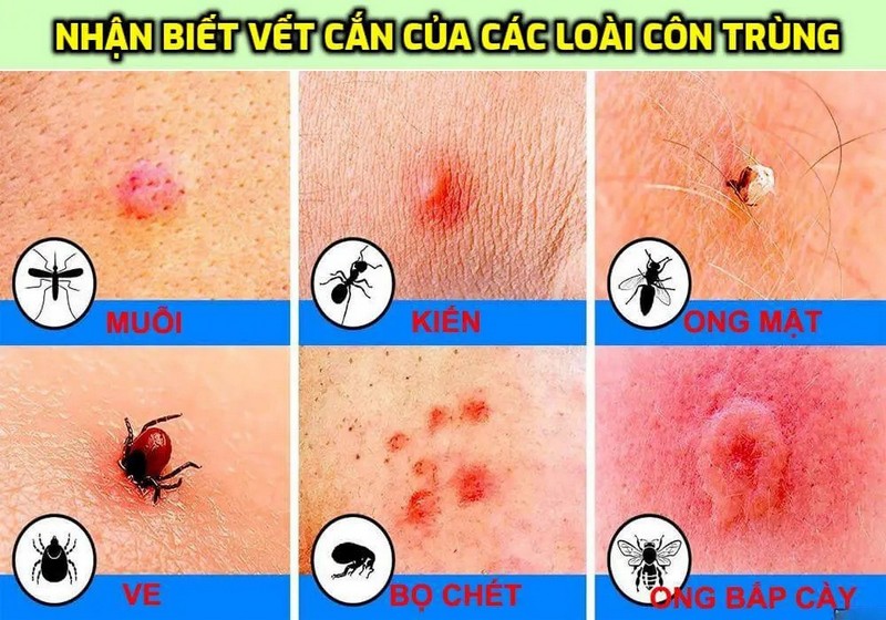 Triệu chứng báo hiệu bạn bị ứng với vết đốt của côn trùng