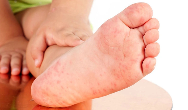 Vì sao muỗi hay đốt chân?