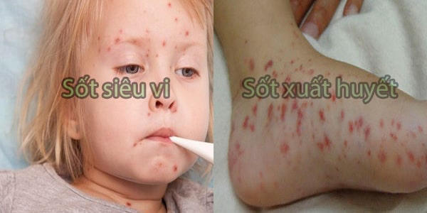 Phân biệt sốt siêu vi và sốt xuất huyết qua triệu chứng