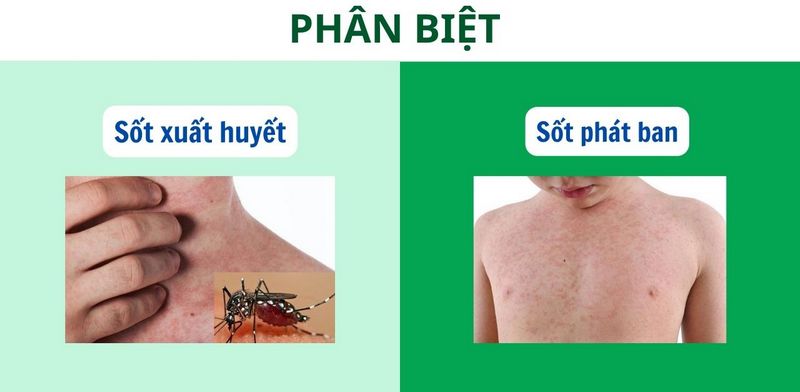 Phân biệt sốt xuất huyết và sốt phát ban