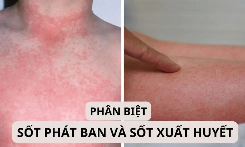 Nguyên nhân gây bệnh - Điểm khác biệt đầu tiên