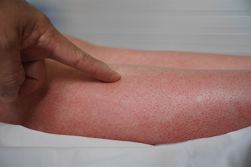 3 Dấu hiệu giúp phân biệt sốt xuất huyết và sốt phát ban