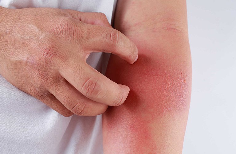 Cần làm gì khi có dấu hiệu ngộ độc thuốc diệt muỗi?