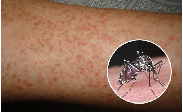 Bị sốt xuất huyết 1 lần rồi có bị lại không?