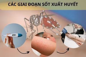 Sốt xuất huyết diễn biến qua mấy giai đoạn chính?