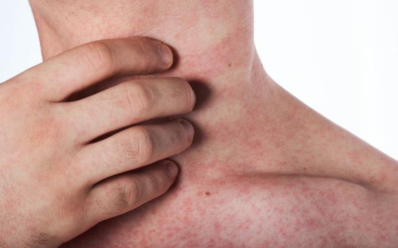 Giai đoạn 2 của bệnh sốt xuất huyết là giai đoạn nguy nhiểm nhất