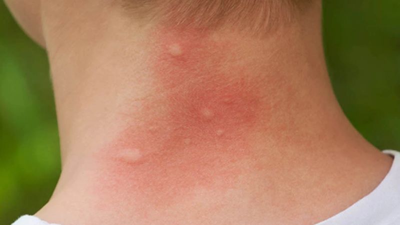 Mối nguy hiểm tiềm ẩn từ một vết đốt nhỏ
