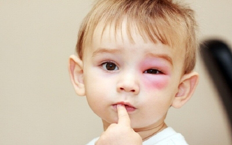 ách xử lý khi bị ong vò vẽ đốt hiệu quả nhất là chườm lạnh