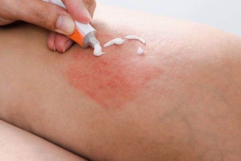 Bị dị ứng côn trùng bôi thuốc gì? Các loại thuốc bôi và uống phổ biến