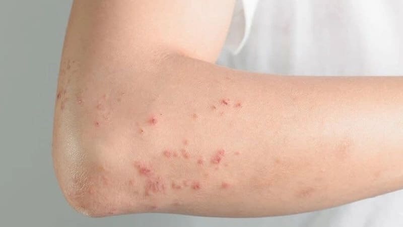 Dị ứng côn trùng bao lâu thì khỏi và các yếu tố ảnh hưởng