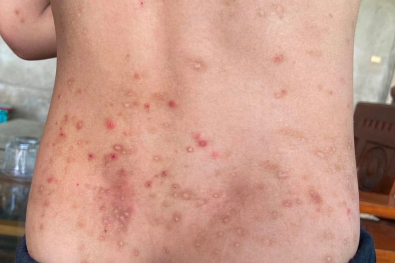 Dị ứng qua da: Phản ứng từ vết cắn và độc tố