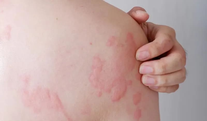 Triệu chứng dị ứng trên da: Ngứa, nổi mề đay, sưng đỏ