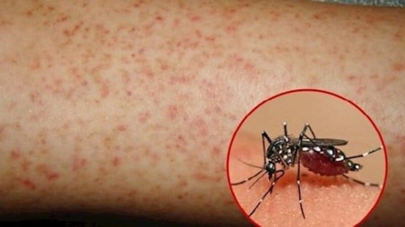 Bệnh sốt xuất huyết nguy hiểm như thế nào?